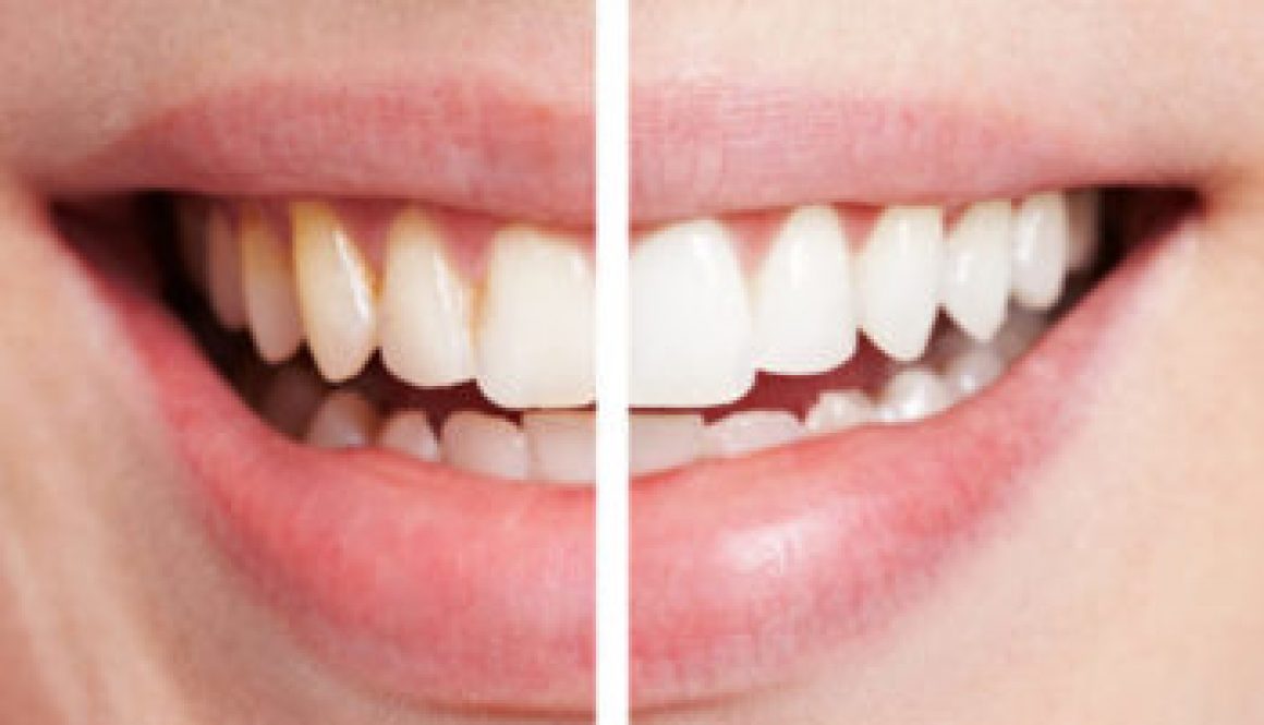 laser-teeth-whitening-e1523937702698